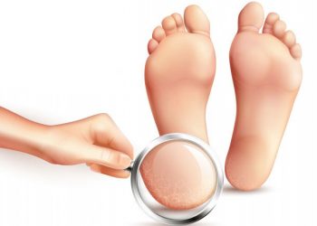 Foot Cream for Cracked Heels