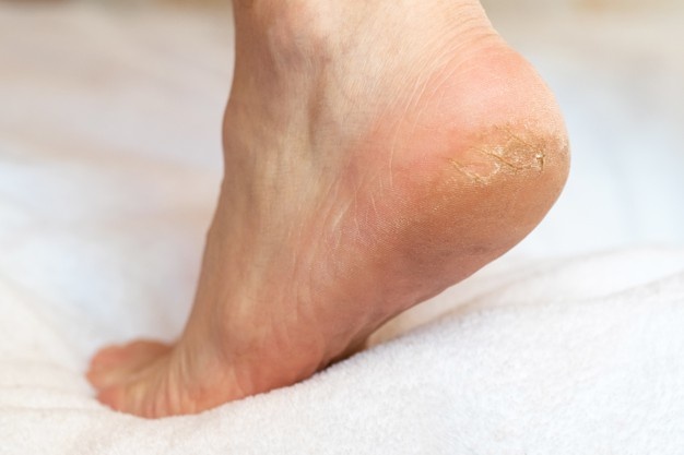 What Causes Cracked Heels?