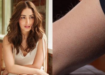 Everything You Need to Know About the Skin Disease Yami Gautam is Battling With