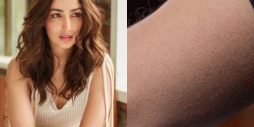Everything You Need to Know About the Skin Disease Yami Gautam is Battling With